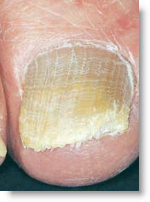 cold laser toenail fungus removal